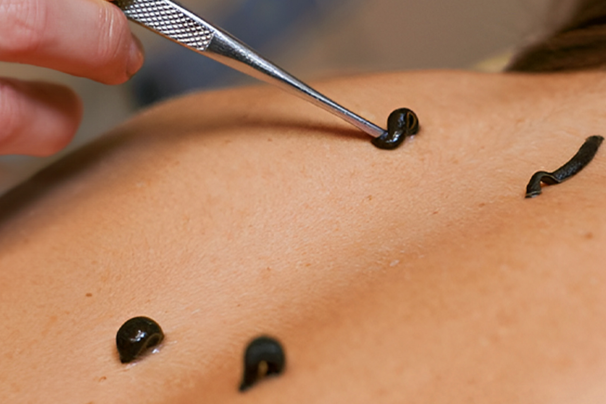 Raktamokshan Therapy